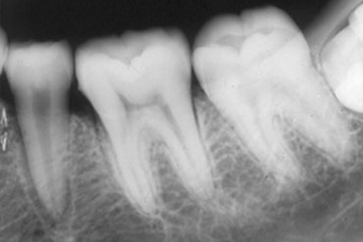 Tooth Anatomy